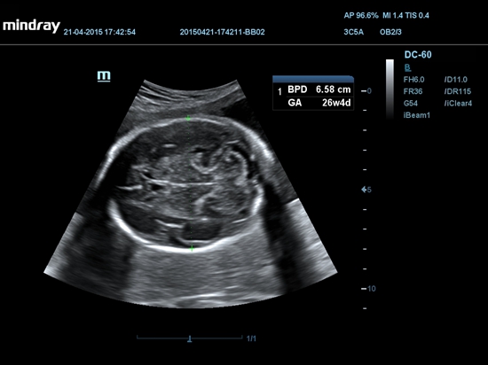 2D Cérebro fetal