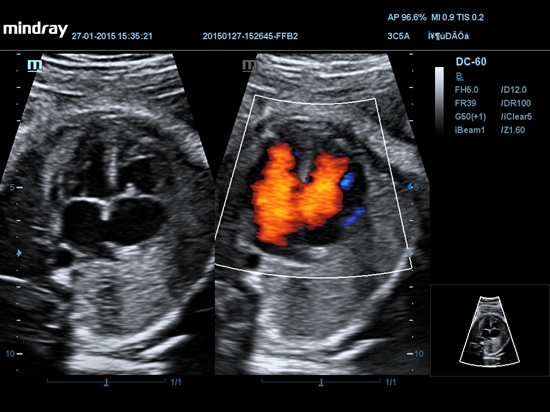 4C Coração fetal com modo duplo