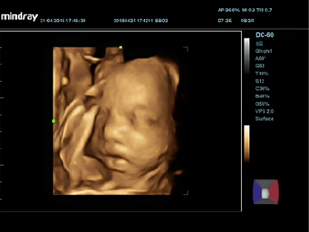 4D Face fetal