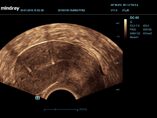 2D Uterino