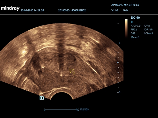 2D Fibroide uterino