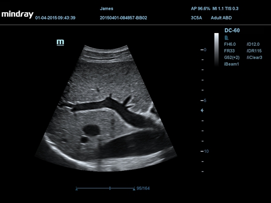 2D Liver PV IVC