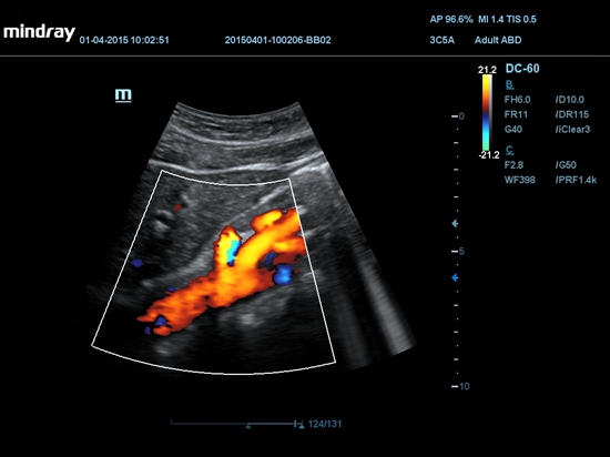 Fluxo de cor da aorta