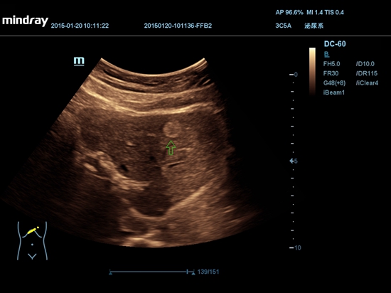 2D Hemangioma hepático