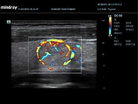 Adenoma da tireoide com HR Flow