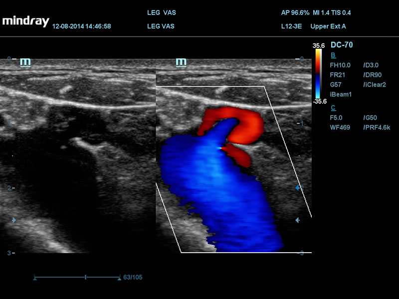 Refluxo da veia jugular