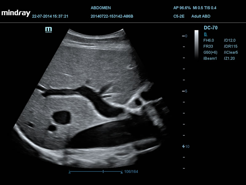 Fígado IVC PV 2D