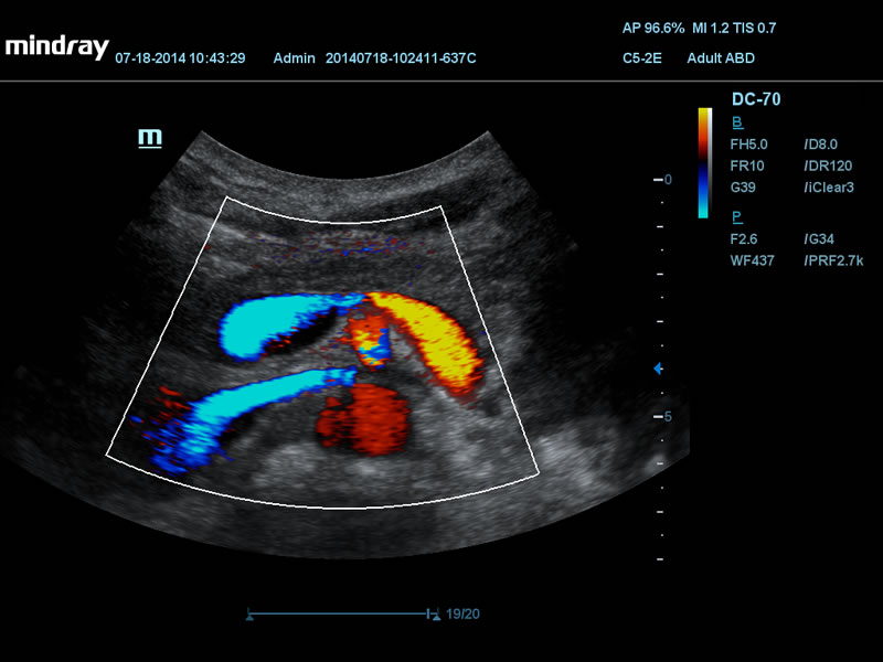 Pâncreas-2D e color doppler