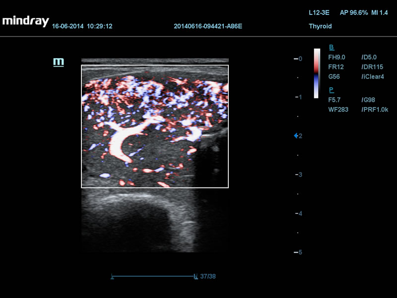 Hipertireoidismo em fluxo colorido de alta resolução