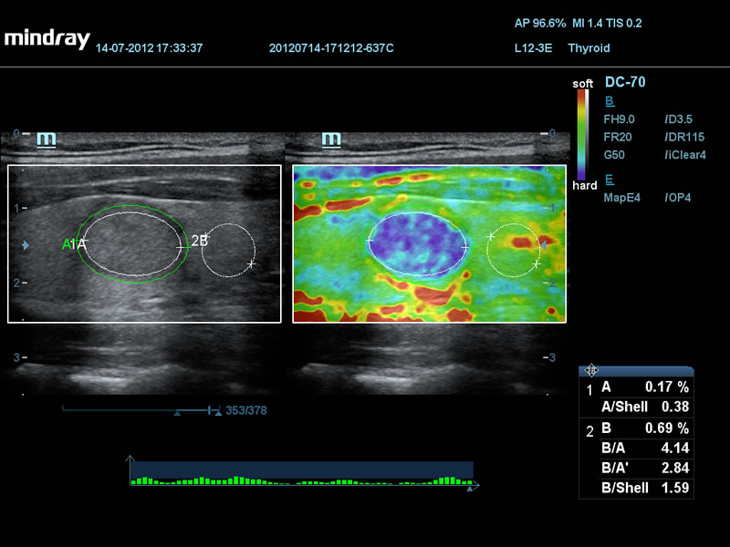 Elastografia de nódulo de tireoide com análise única do invólucro
