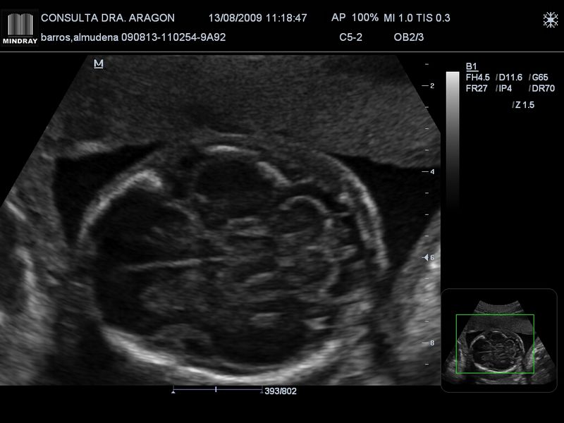 Cérebro fetal (zoom)