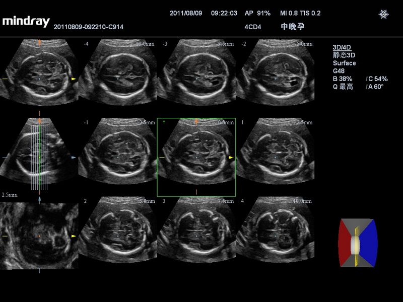 Cérebro fetal - iPage™