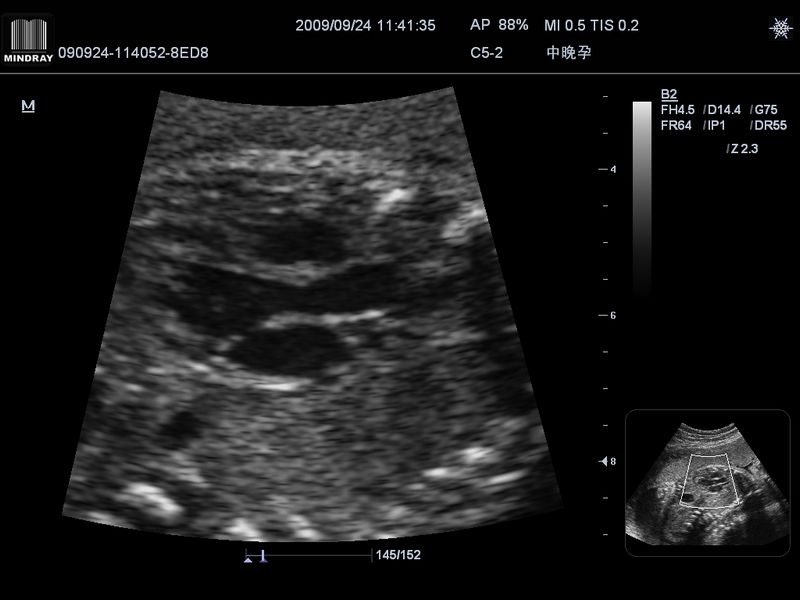 Coração fetal no modo B (zoom)