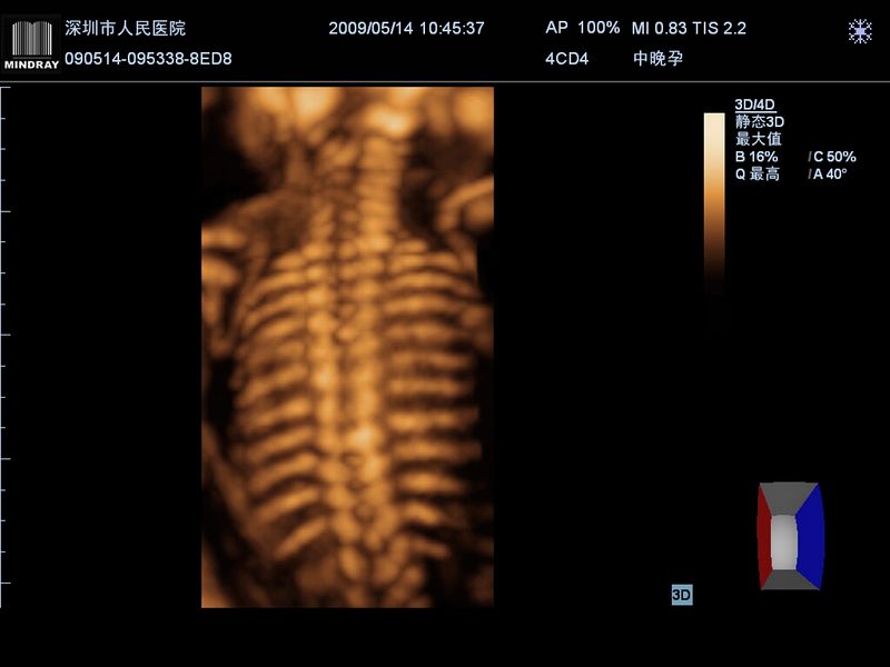 Coluna vertebral fetal-3D