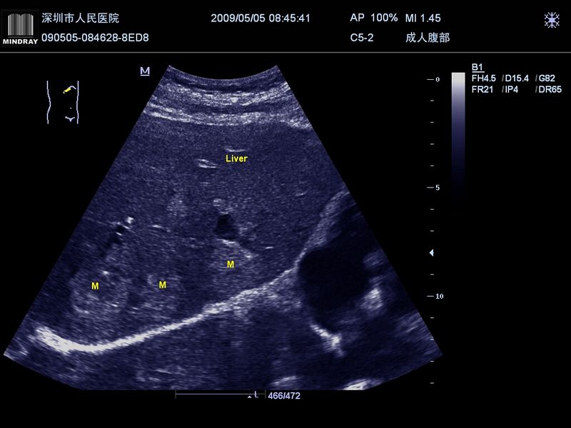 Tumor hepático