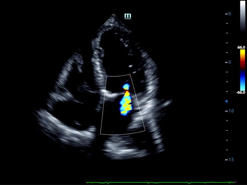 Vista da regurgitação mitral - quatro câmeras (Doppler colorido)