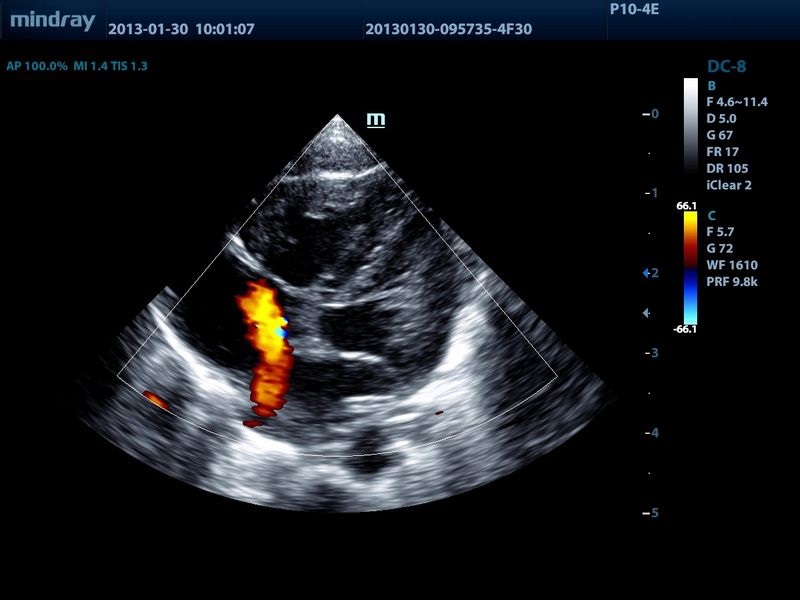 Eco de neonato PFO