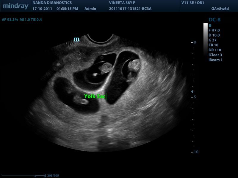 Vesícula umbilical e embrião