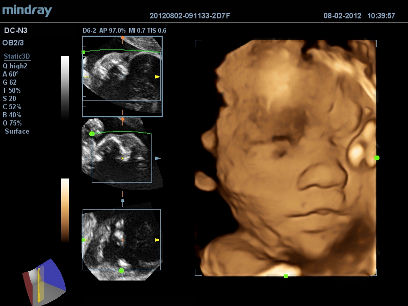 Face fetal 4D