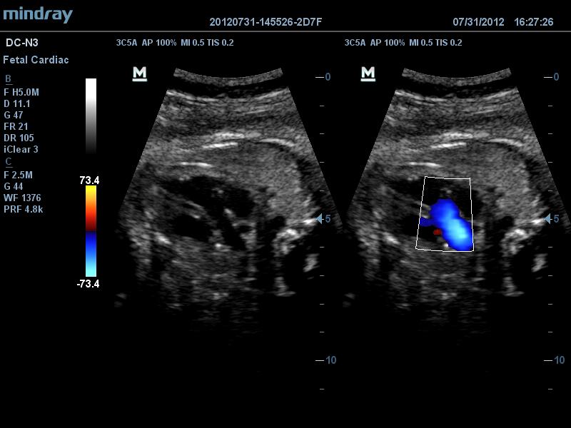 Via de saída ventriculo esquerdo fetal