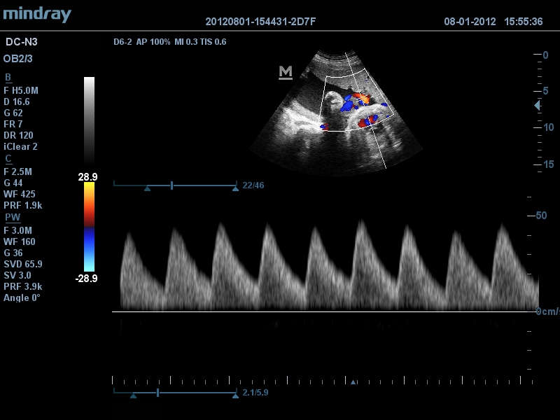 Fluxo e PW coloridos da artéria umbilical