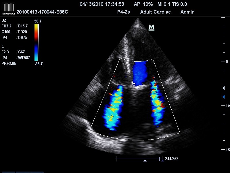 Regurgitação mitral e tricúspide