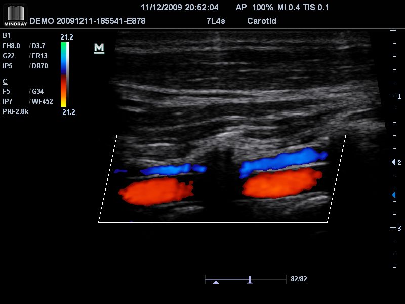 Fluxo vertebral