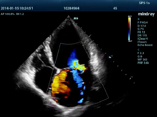 Incompetência Mitral Color