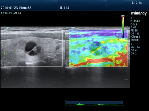 Elastografia de cisto em tireoide