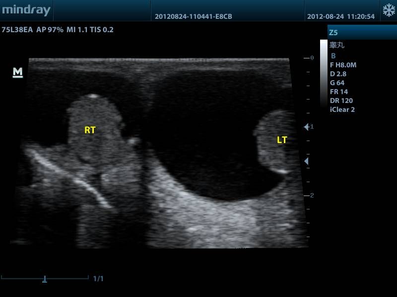 Hidrocele testicular