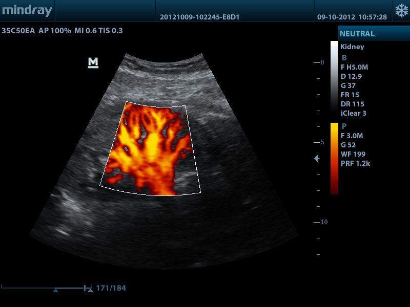 Power Doppler renal